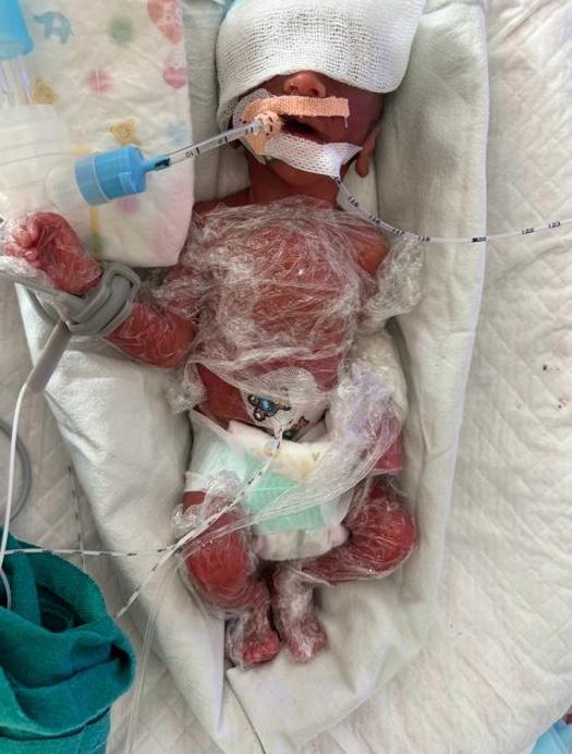 Premature baby in modern NICU incubator